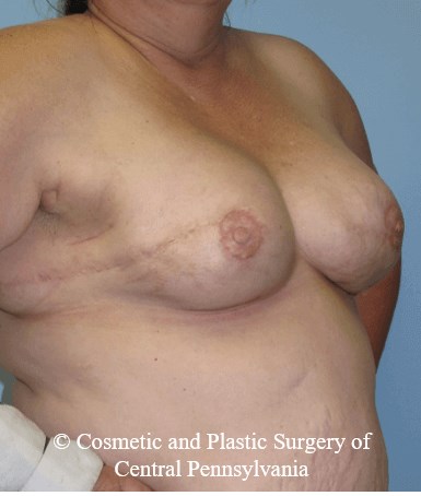 Breast Reconstruction After