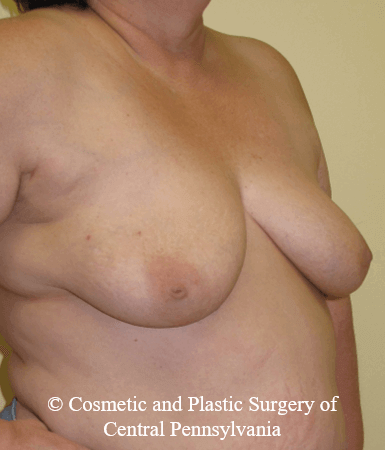 Breast Reconstruction Before