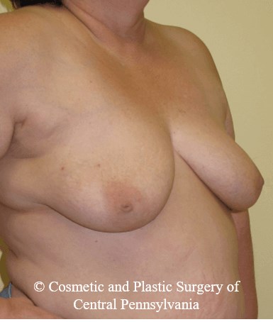 Breast Reconstruction Before