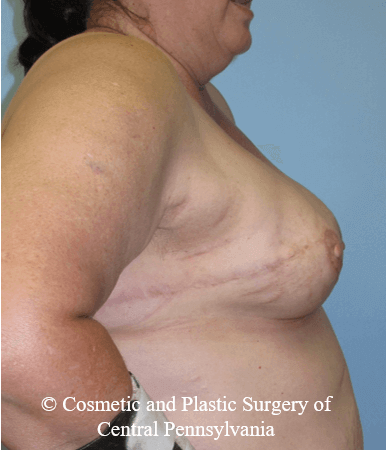 Breast Reconstruction After