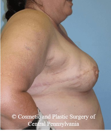Breast Reconstruction After
