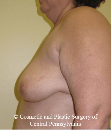 Breast Reconstruction Before