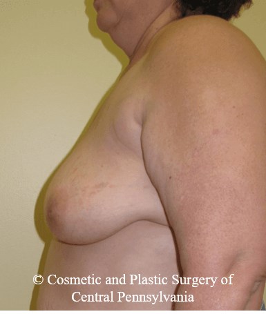 Breast Reconstruction Before