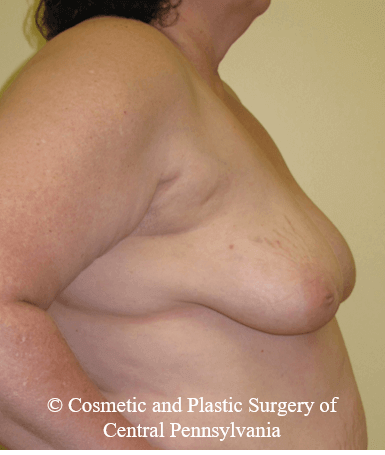 Breast Reconstruction Before
