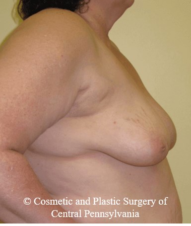 Breast Reconstruction Before
