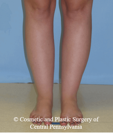 Lower Leg Liposuction Before