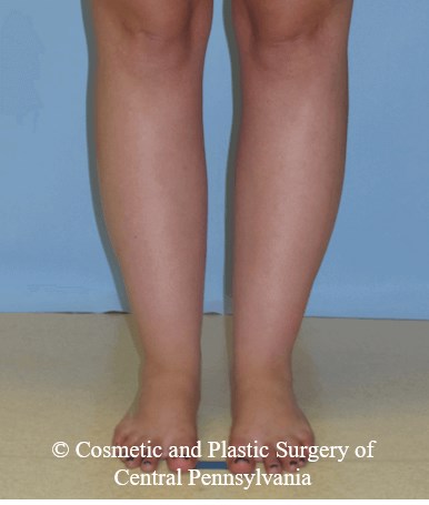Lower Leg Liposuction Before