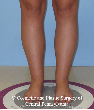 Lower Leg Liposuction After