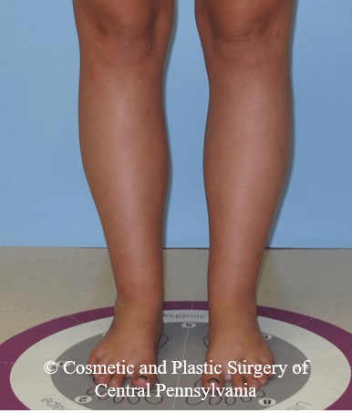 Lower Leg Liposuction After