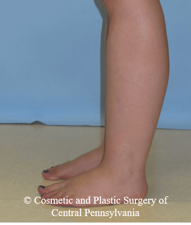 Lower Leg Liposuction Before