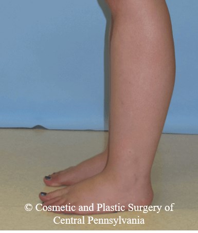 Lower Leg Liposuction Before