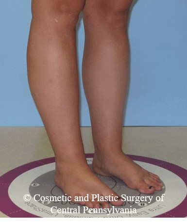 Lower Leg Liposuction After