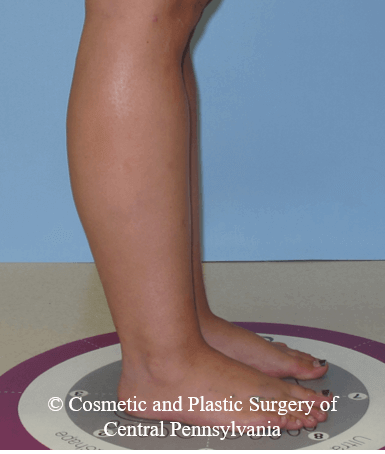 Lower Leg Liposuction After