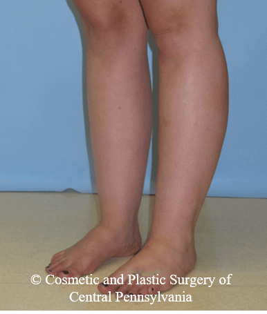 Lower Leg Liposuction Before