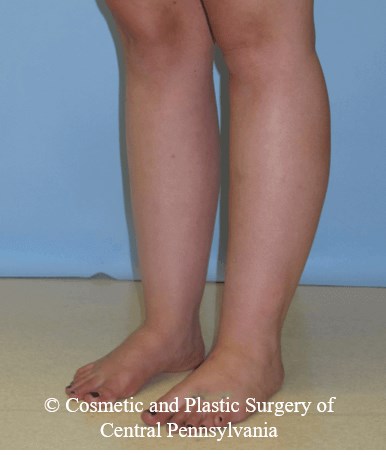 Lower Leg Liposuction Before