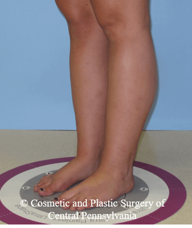 Lower Leg Liposuction After