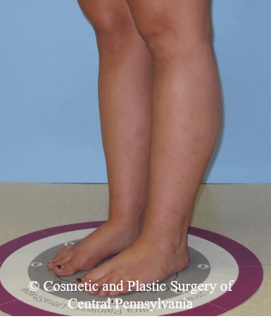 Lower Leg Liposuction After