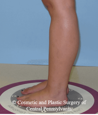 Lower Leg Liposuction After