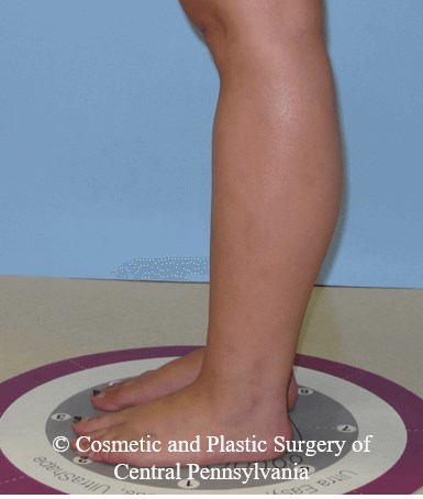 Lower Leg Liposuction After