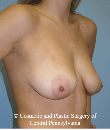 Breast Lift (Mastopexy) Before