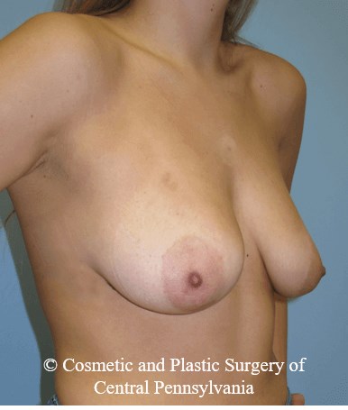 Breast Lift (Mastopexy) Before