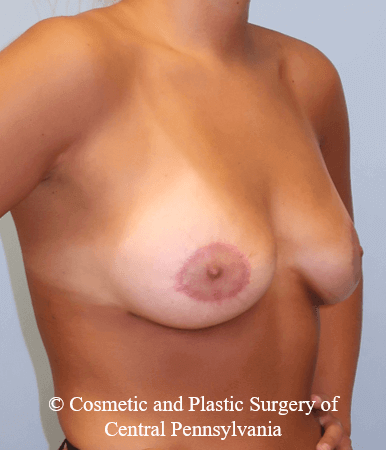 Breast Lift (Mastopexy) After