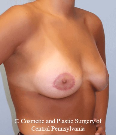 Breast Lift (Mastopexy) After