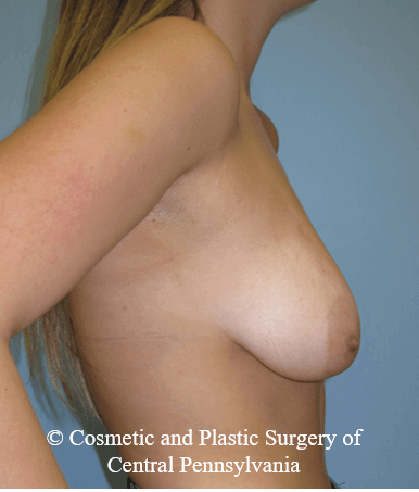 Breast Lift (Mastopexy) Before