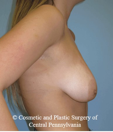 Breast Lift (Mastopexy) Before