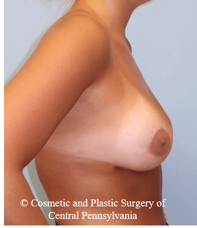 Breast Lift (Mastopexy) After