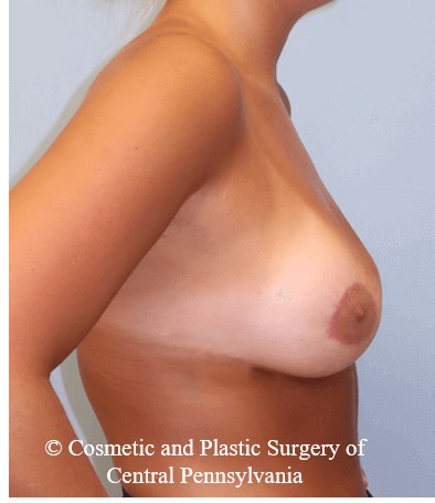 Breast Lift (Mastopexy) After
