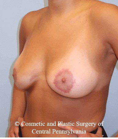 Breast Lift (Mastopexy) After