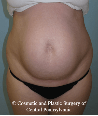 Abdominoplasty Before