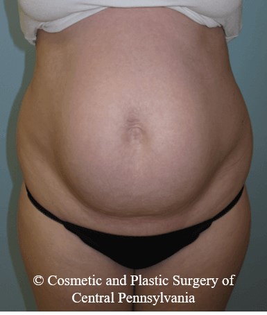 Abdominoplasty Before