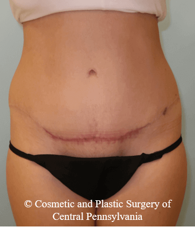 Abdominoplasty After