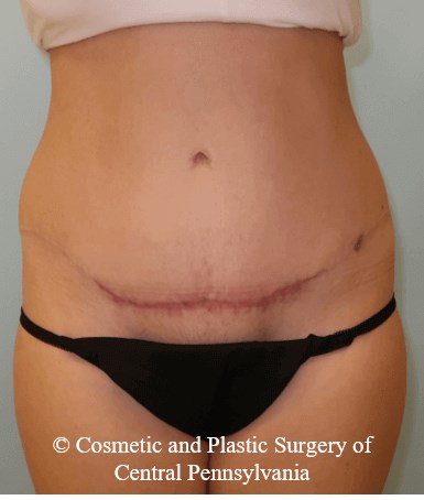 Abdominoplasty After