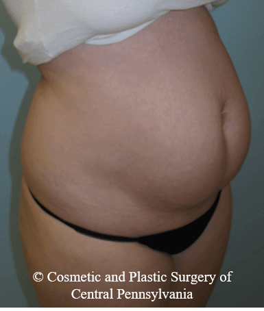 Abdominoplasty Before