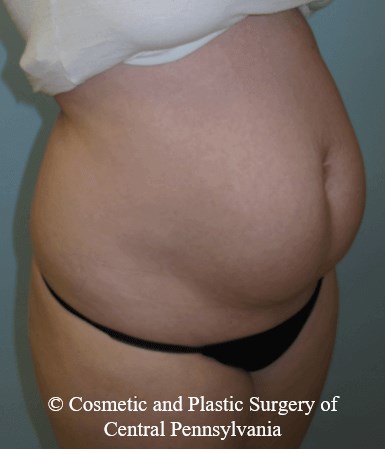 Abdominoplasty Before