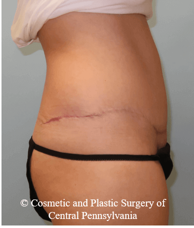 Abdominoplasty After