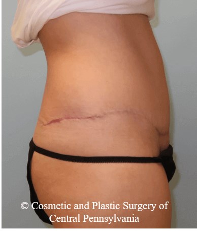 Abdominoplasty After