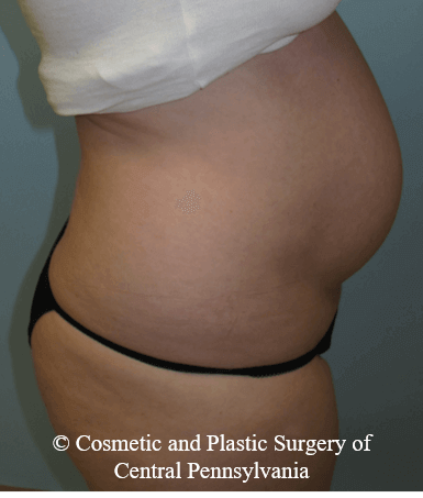 Abdominoplasty Before