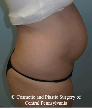 Abdominoplasty Before