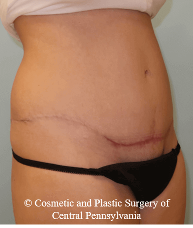 Abdominoplasty After