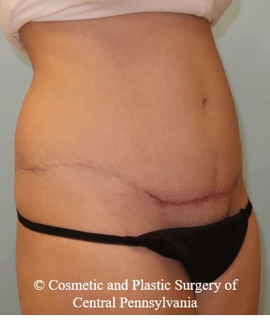 Abdominoplasty After