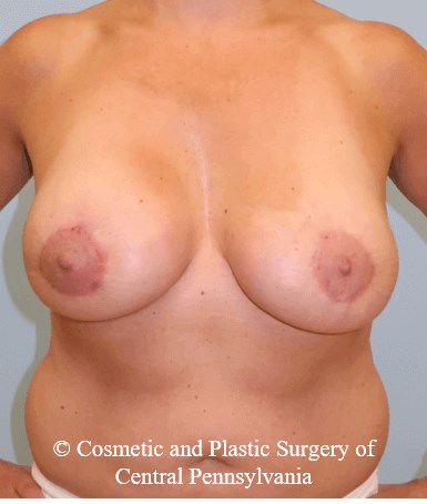 Breast Augmentation Lift After