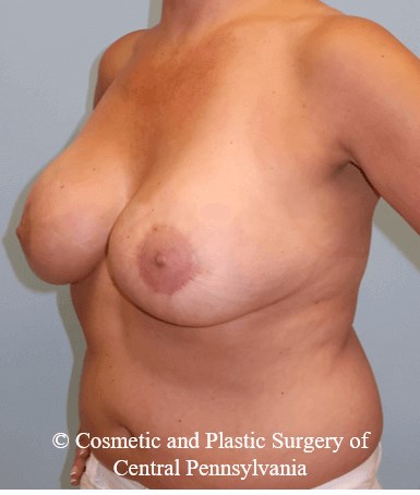 Breast Augmentation Lift After