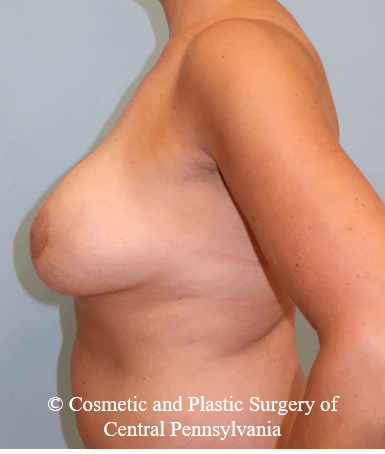 Breast Augmentation Lift After