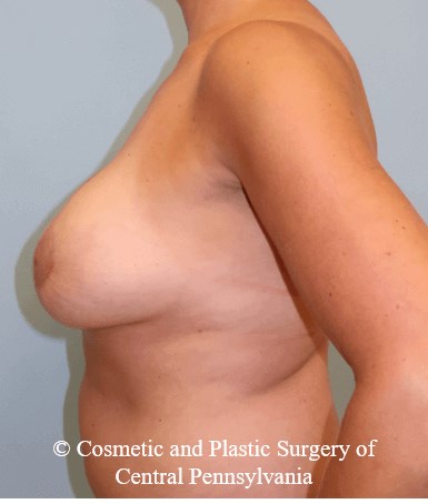 Breast Augmentation Lift After