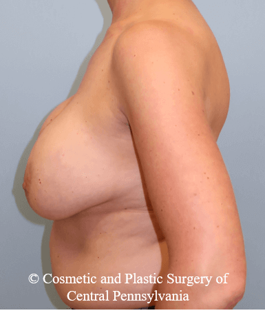 Breast Augmentation Lift Before