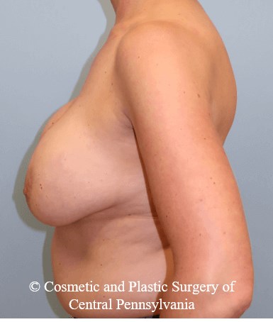 Breast Augmentation Lift Before